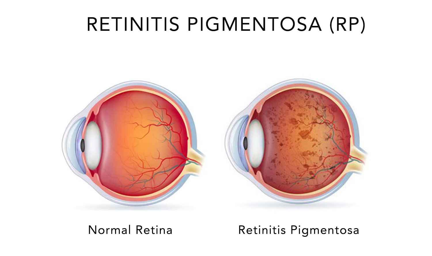 tratamiento retinitis pigmentaria