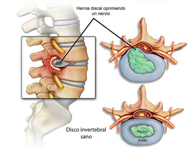 hernia discal 