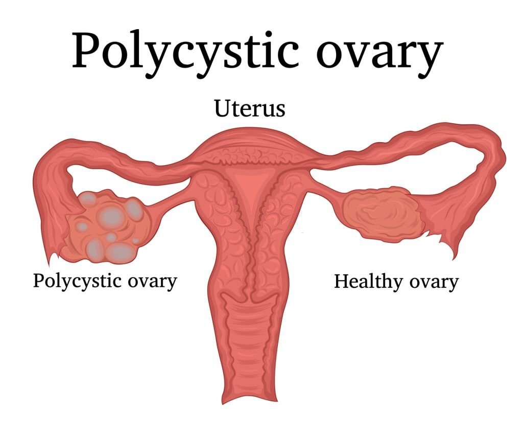 sindrome de ovario poliquistico