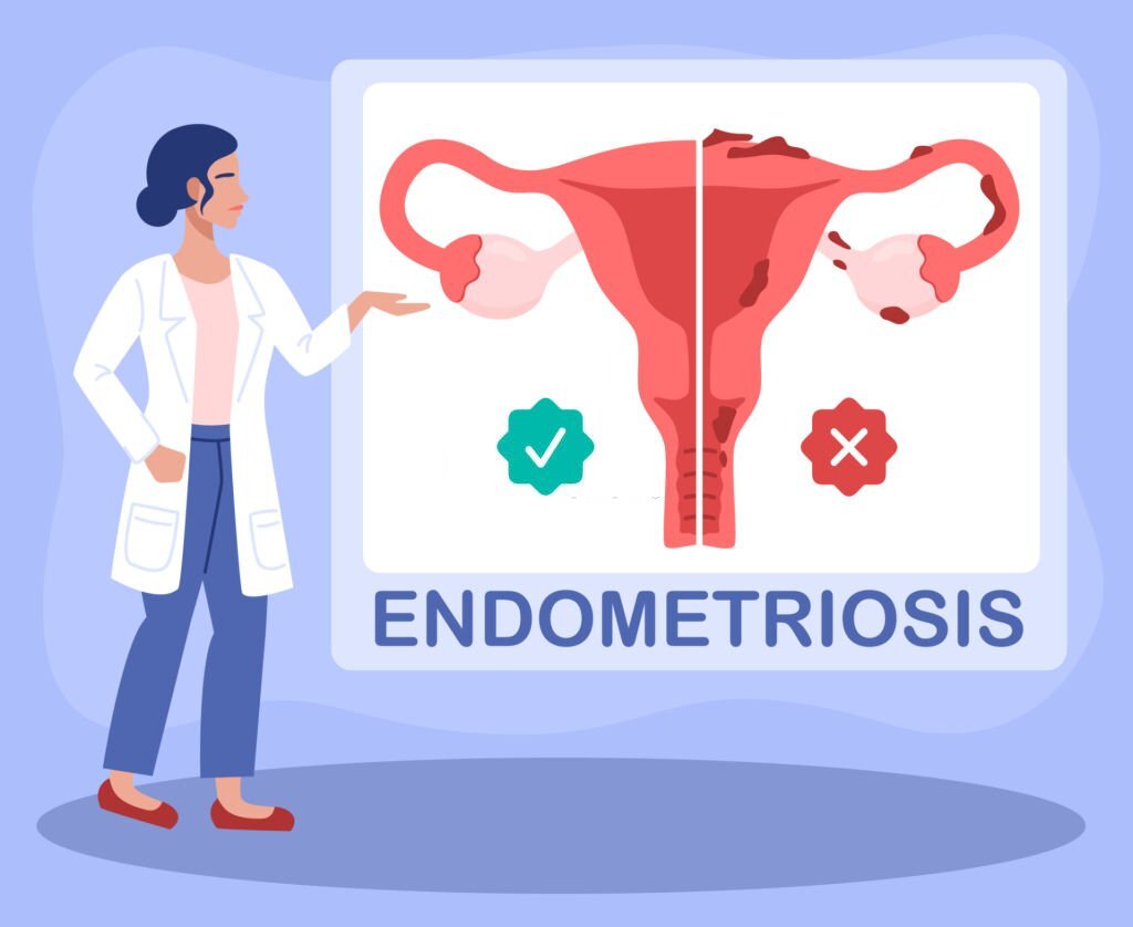 Endometriosis Ayurveda